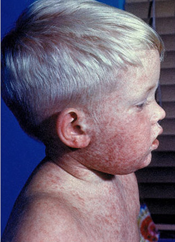 rougeole masern measles