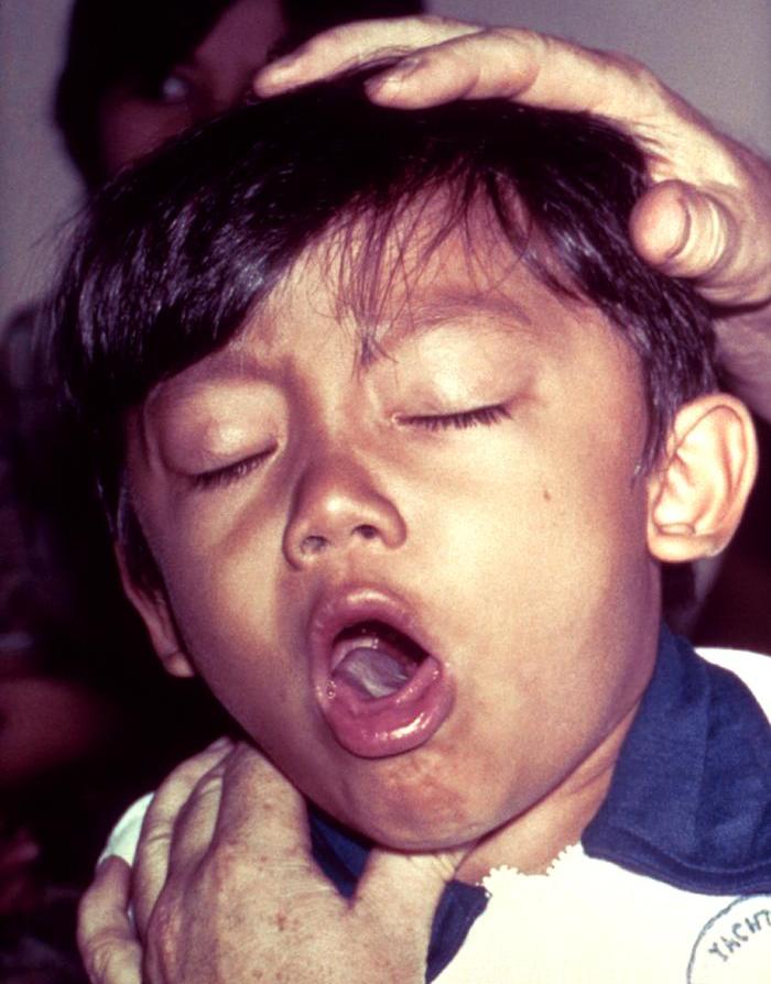doença da tosse convulsa 1